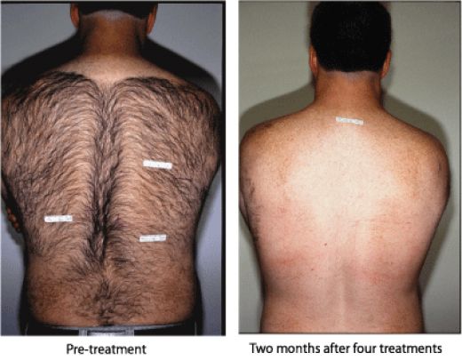 Laser Hair Removal For Men