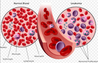 Leukemia