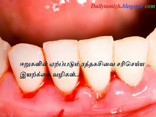 eeru ratha kasivu iyarkkai maruthuvam natural remedy for bleeding gum