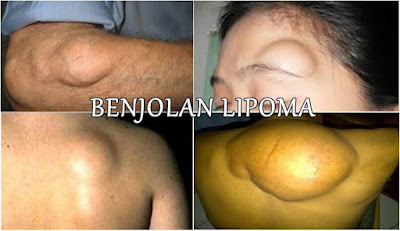 Menangani Lipoma dengan mudah dan bisa dilakukan di Rumah