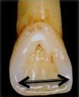 landmarks of the teeth | Elevated landmarks & Depresses landmarks.