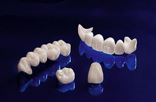 Độ bền răng sứ titan có lâu không
