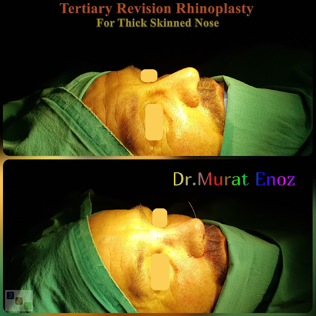 revision rhinoplasty, tertriary rhinoplasty for men istanbul, 3rd nose job, 3rd nose aesthetic surgery, micromotor assisted revision rhinoplasty, micro-motor assisted revision nose asthetic surgery