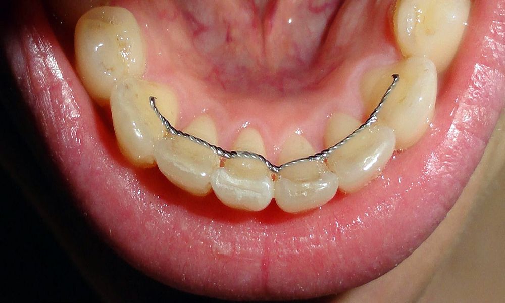 Orthodontic