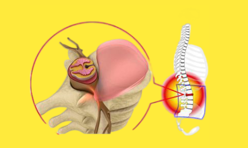 O que é Hérnia de Disco? Hérnia de disco é uma doença bastante...