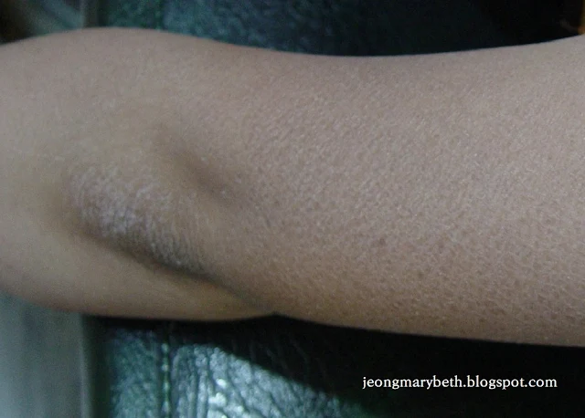 Acquired Ichthyosis (3) Image 2