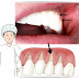 Desgaste no colo dos dentes⎮Causas e Solução ⎮Abfração dentária
