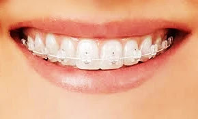 appareil dentaire céramique