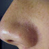 Cara Menghilangkan atau Membersihkan Komedo di wajah dan Hidung
