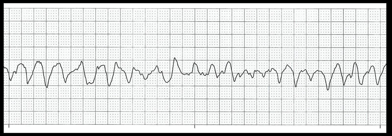 test ekg heart 07 Basic Rhythm EKG Nurse: Float Test test ekg heart 07 Basic Rhythm EKG Nurse: Float Test