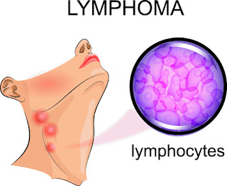 Lymphocytes and Lymphoma