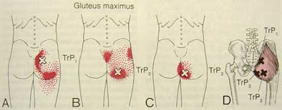 MIOTERAPIA