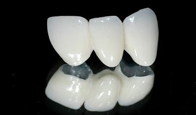 Quy trình thực hiện bọc răng sứ titan