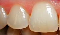 Age Changes in Enamel Dentin and Pulp