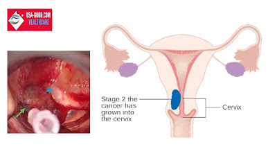 What is Vaginal Cancer?