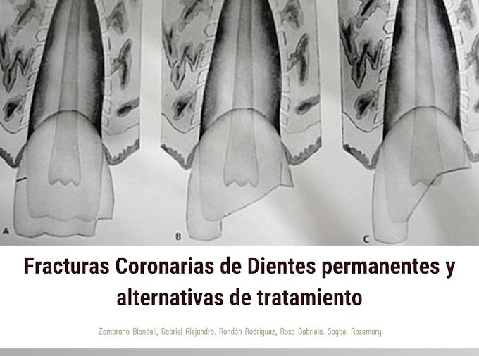 Fracturas Coronarias de Dientes permanentes y alternativas de tratamiento