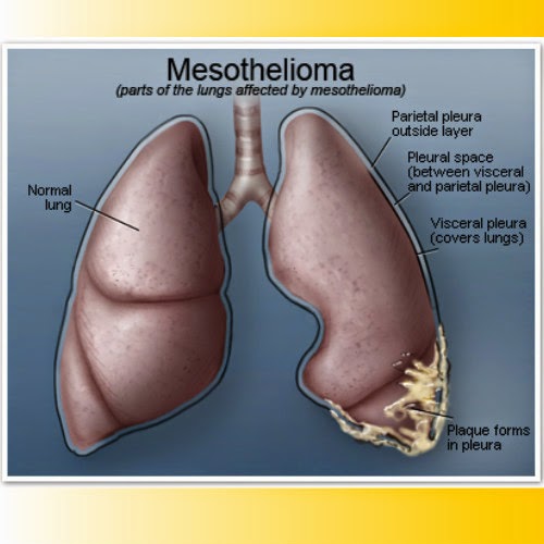 http://www.moreaboutmesothelioma.com/