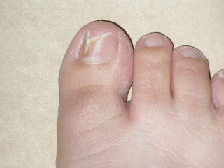 Toenail Fungus