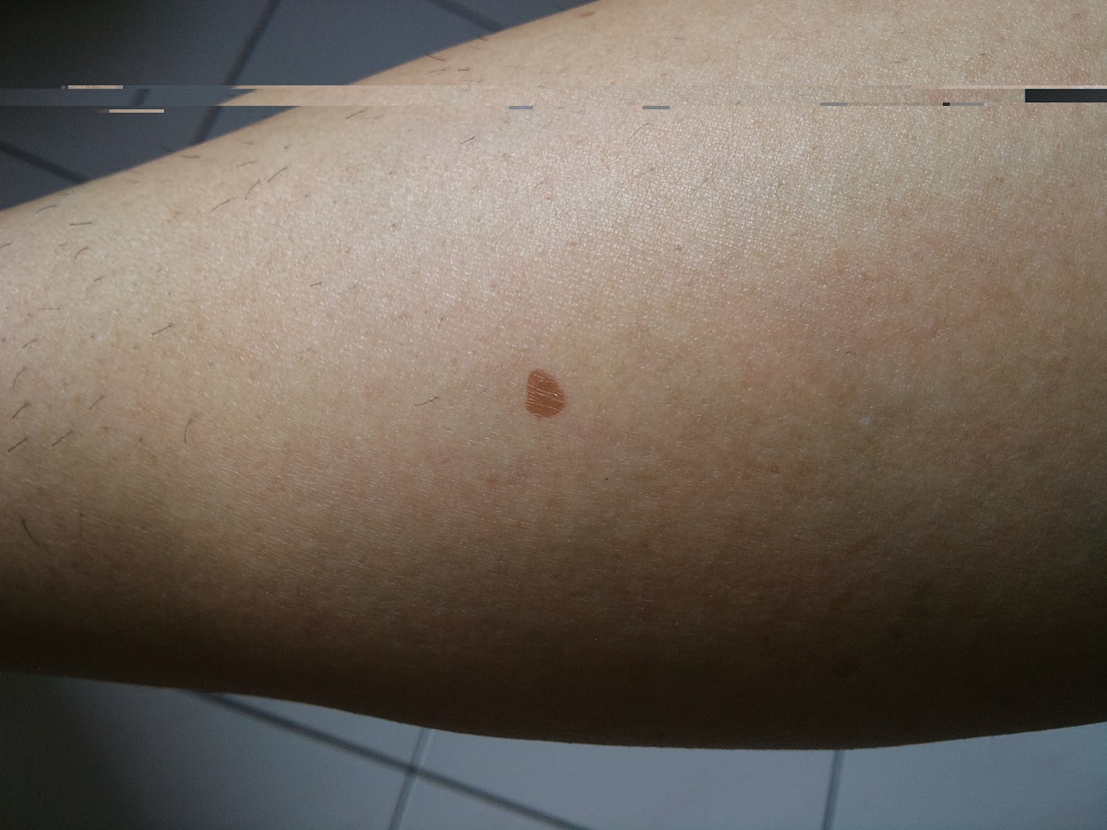 I Live In Kk Old Age Spot Liver Spot