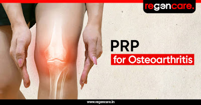 prp-for-osteoarthritis