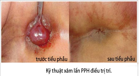 Cắt trĩ ngoại bằng kỹ thuật nào tốt nhất hiện nay