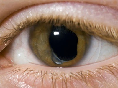 Tip dan Petua: Tips Penjagaan Mata Selepas Pembedahan Katarak