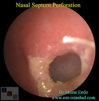 Nasal Septum Perforation