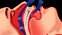 Can Sleep Apnea Cause Headaches