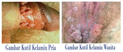 Penyakit kutil genital - de Nature