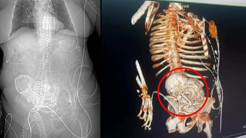 Idosa de 86 anos descobre  feto mumificado