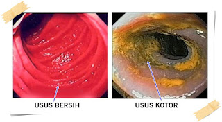 Gejala Awal Dan Cara Menyembuhkan Penyakit Usus Buntu