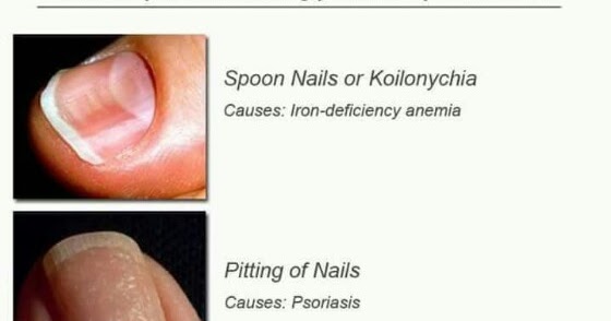 The truth behind pitting of nails in psoriasis - Doctor Rekha