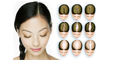 Male Pattern Baldness Affect on FEMALE