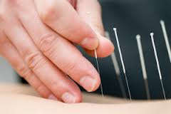 belajar pengobatan akupuntur