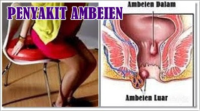 Obat Khusus Penyakit Ambeien