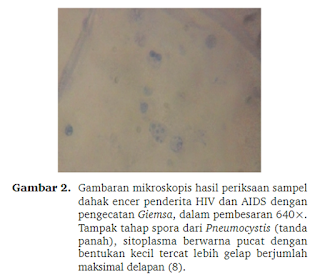 Gambaran Mikroskopis dahak encer penderita hiv aids.png