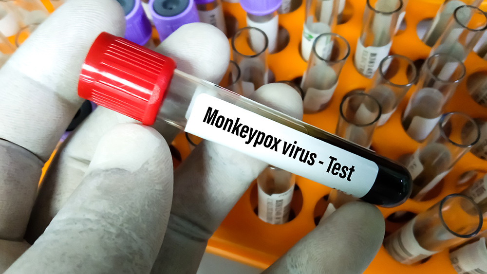 “Monkeypox” is only circulating in countries where the Pfizer Vaccine has been distributed & is being used to advance a Technocratic Great Reset