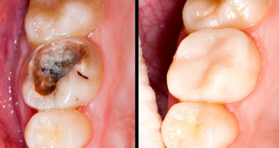 Reverse Cavities And Heal Tooth Decay With These 5 Steps!
