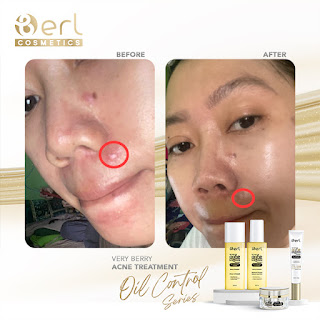 Testimoni B Erl Acne Series