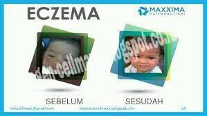 CellMaxx Obat herbal Eczema/Eksim