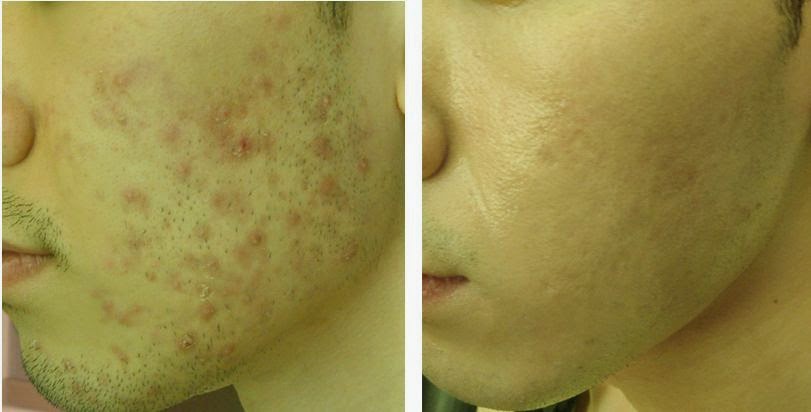 How To Get Rid Of Acne Marks 3 Home Remedies For Acne Scar Removal ...