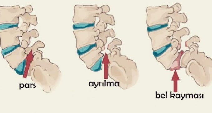Spondilolistezis Nedir?