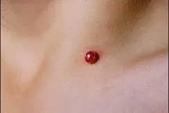 Cara Menghilangkan Granuloma