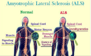 Artikel, Amyotrophic Lateral Sclerosis (ALS), ALS Adalah, Dampak ALS, Penyebab ALS, Prognosis Pasien ALS, Pengobatan ALS