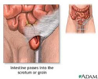 Turun Berok (Hernia)