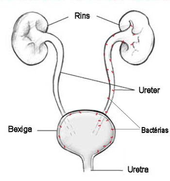 Pielonefrite - Bactérias da bexiga subindo para os rins