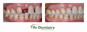 Dental Implants, Orthodontic Treatments