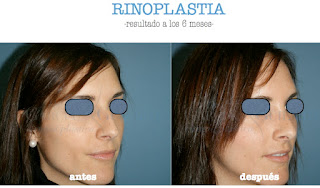 rinoplastia_operacion_nariz_cirujano_plastico