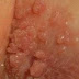 Obat Kutil Kelamin Malaysia thumbnail