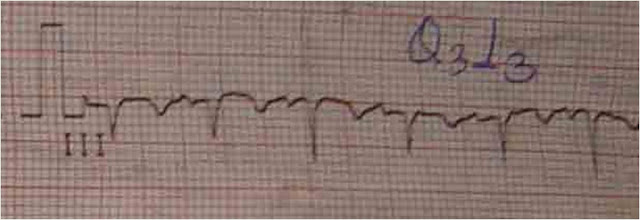 pulmonary embolism ecg